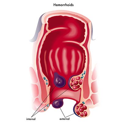 Choroba hemoroidalna