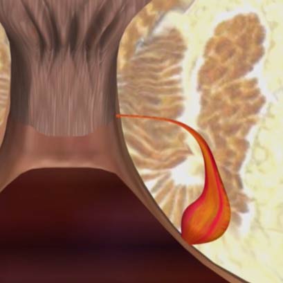 Przetoka okołoodbytnicze laserem