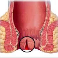 Usuwanie szczeliny odbytu