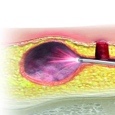 Torbiel włosowa laserem